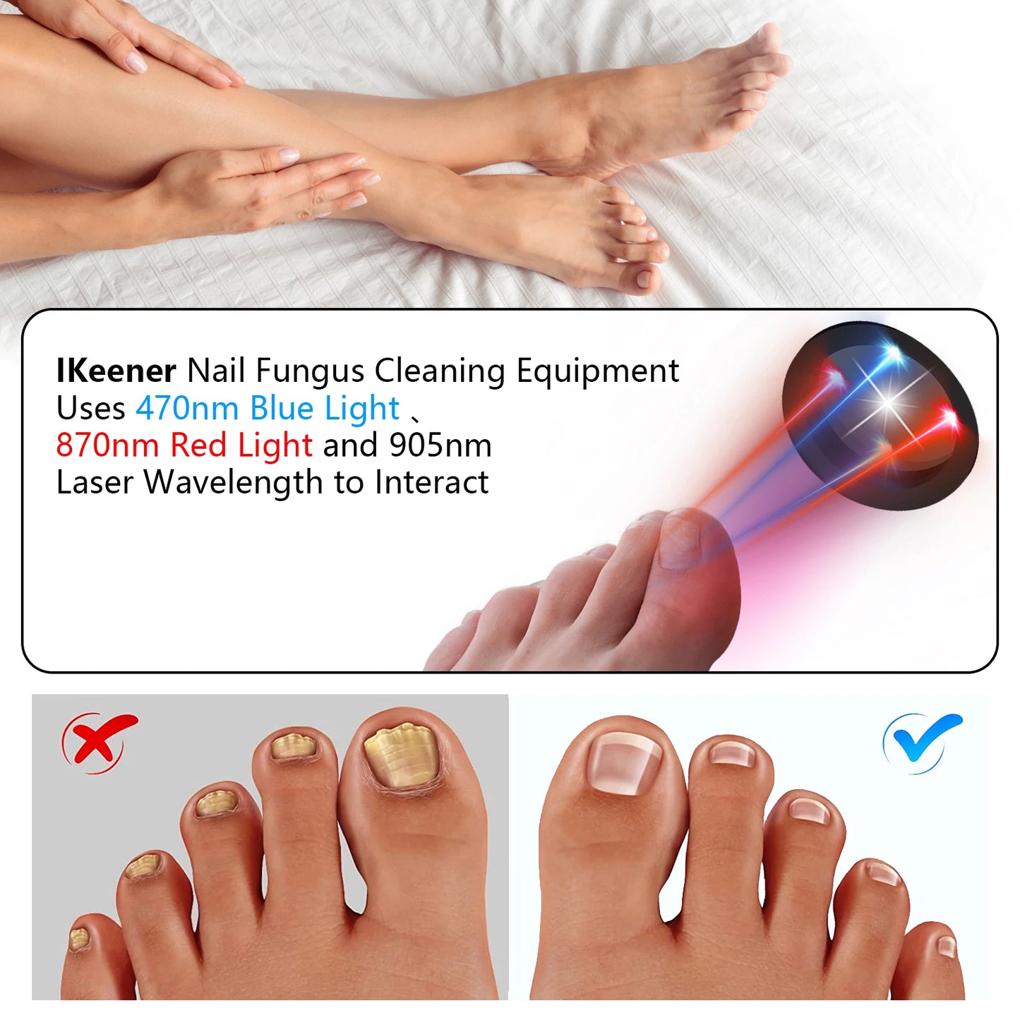 Toenail Fungus Treatment Device With 470nm And 905nm Infrared Light